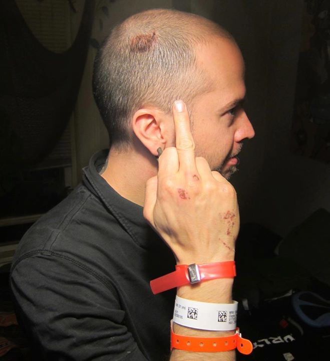 Right side view of person with a scraped up hand, pointing to an injury on their head, with their middle finger