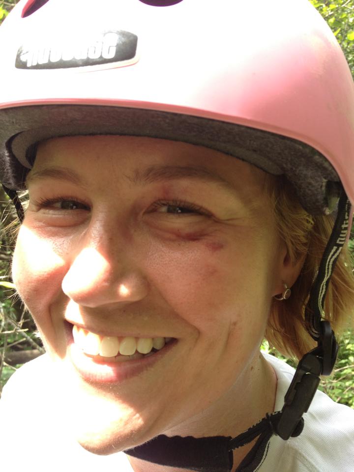 Head shot of a smiling person, wearing a bike helmet, with a bruised left eye