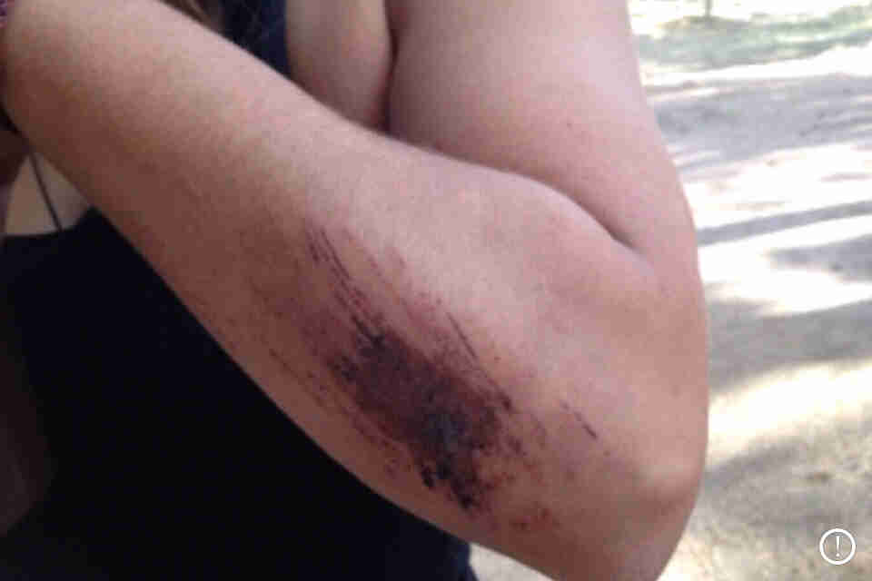 Cropped view of a person's scraped up forearm