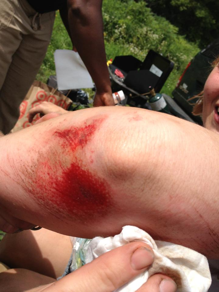 A person's bloody and scraped up elbow, with a person standing behind in grass